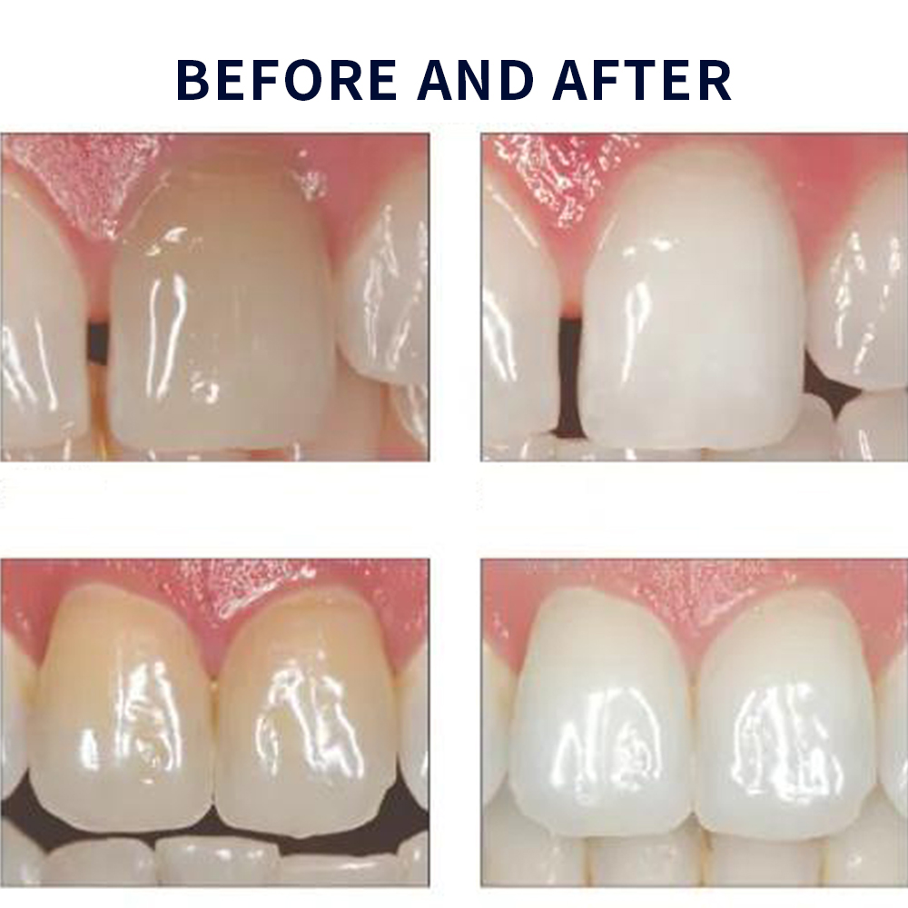 Opalescence Whitening 20% PF 2 - đánh giá và giá Teeth Whitening Groupon