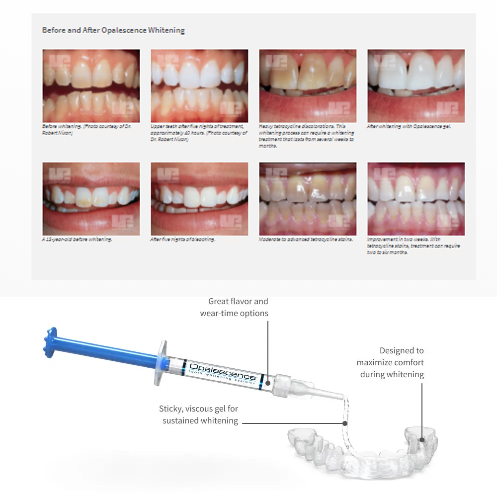 Opalescence Whitening 20% PF 2 - đánh giá và giá Teeth Whitening Groupon
