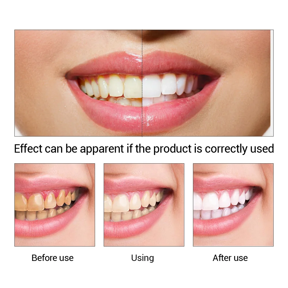 FTEENPLY Làm Trắng Răng Tinh C - đánh giá và giá Teeth Whitening Groupon