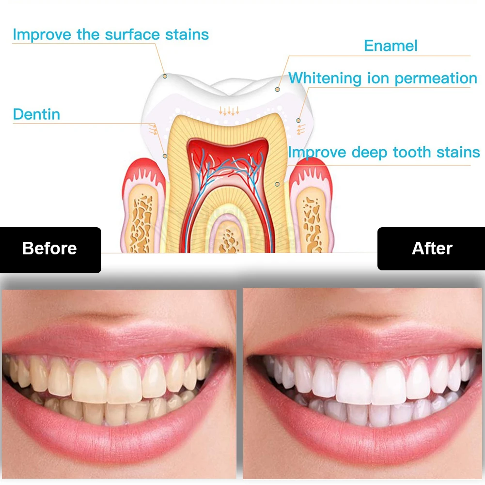 Dental Teeth Whitening Kit Min - đánh giá và giá Teeth Whitening Zoom