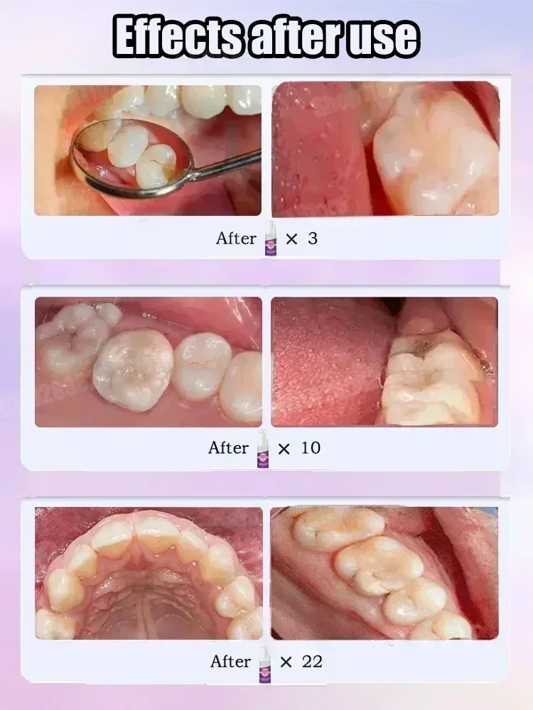 Teeth Cleaning Toothpaste Remo - đánh giá và giá Teeth Whitening That Works